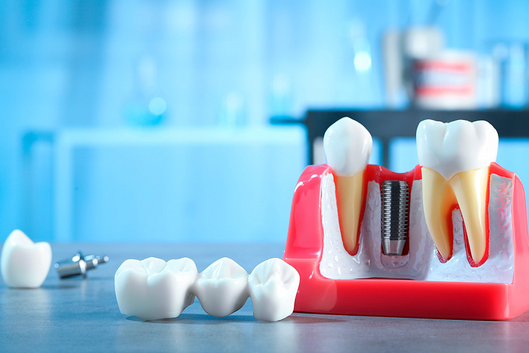 Виды стоматологических прокладок и их отличия